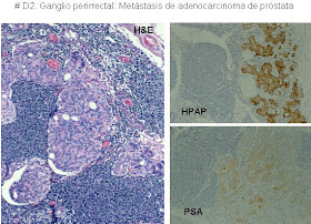 origen del adenocarcinoma de próstata